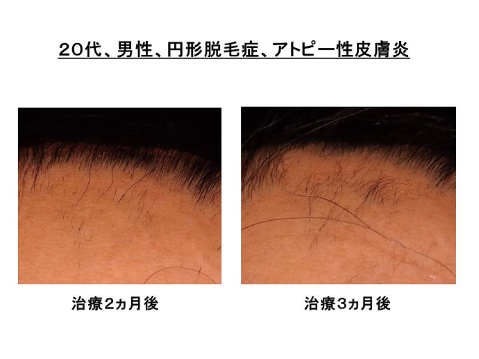 円形脱毛症　病院""